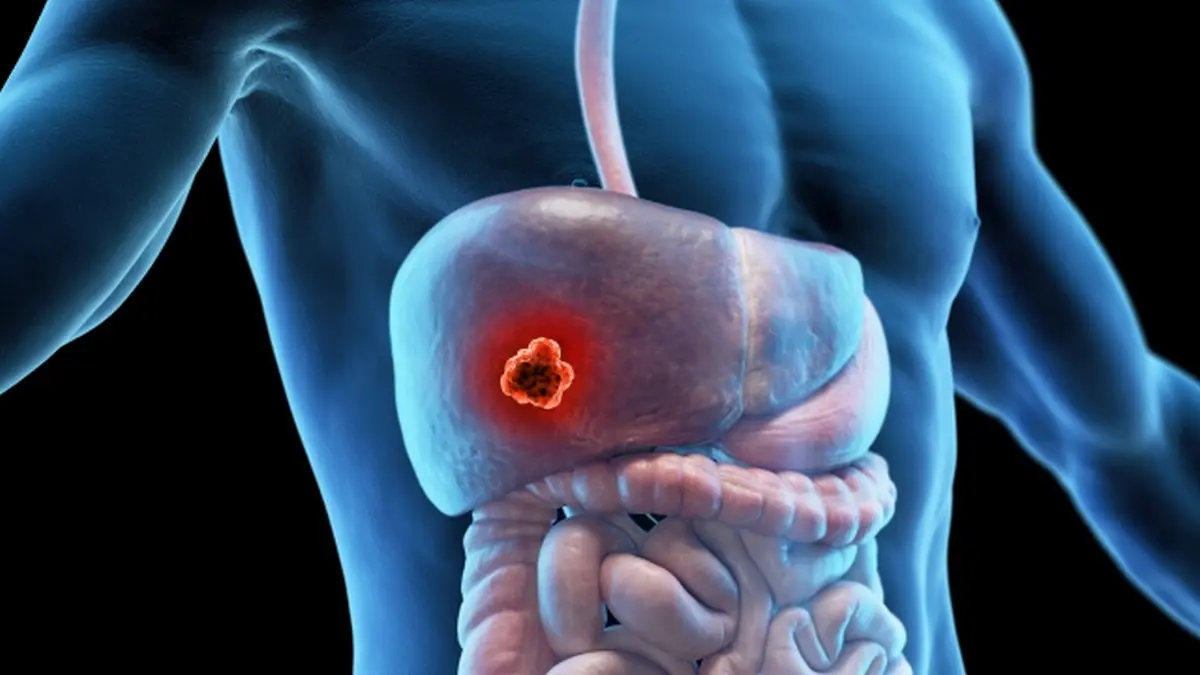 Wissenschaftliche Darstellung des menschlichen Körpers mit hervorgehobenem Tumor in der Leber, symbolisiert die Forschung zur Entstehung von hepatozellulärem Karzinom durch TET2-mutierte klonale Hämatopoese.