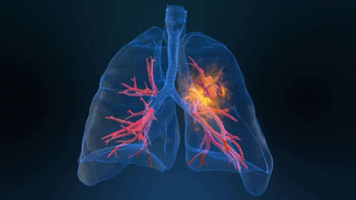 3D-Darstellung der menschlichen Lunge mit hervorgehobenen Tumorbereichen. Es illustriert die Forschung zu EML4-ALK-Fusionen und deren Einfluss auf die Therapie von Lungenkrebs