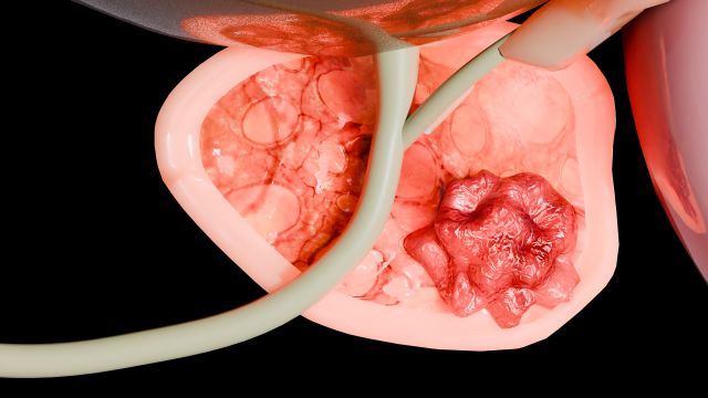 Darstellung eines metastasierten Prostatakarzinoms mit Tumorgewebe und medizinischen Instrumenten.