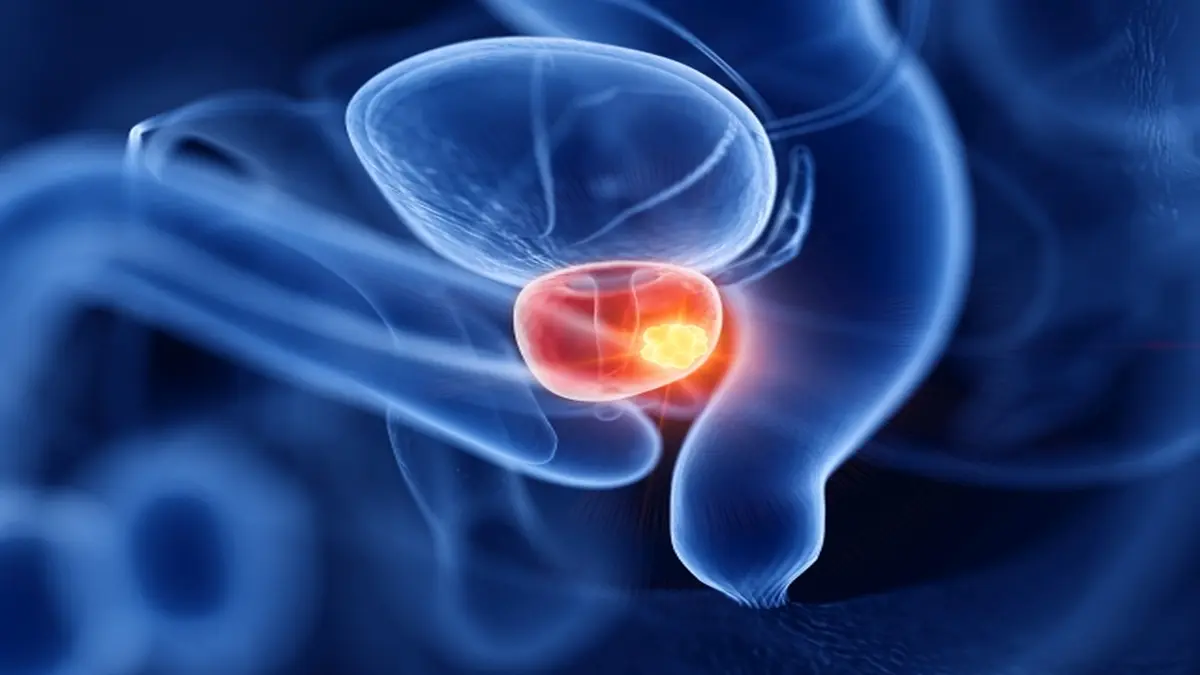 Wissenschaftliche Darstellung der Prostata mit hervorgehobenem Tumor, symbolisiert die Diagnose und Forschung zu Prostatakrebs bei jungen Patienten.