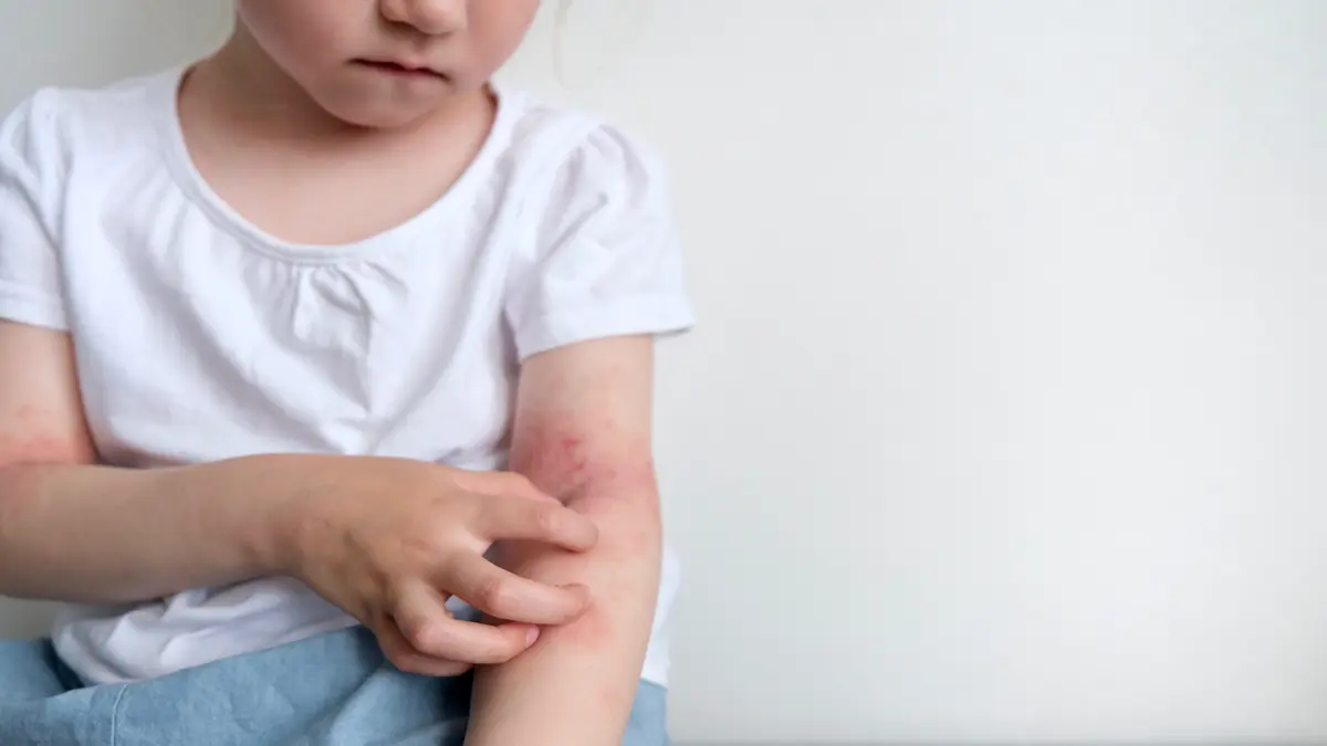 Kind in weißem T-Shirt kratzt sich am Arm, auf dem gerötete, entzündete Hautstellen sichtbar sind – Anzeichen von Neurodermitis.
