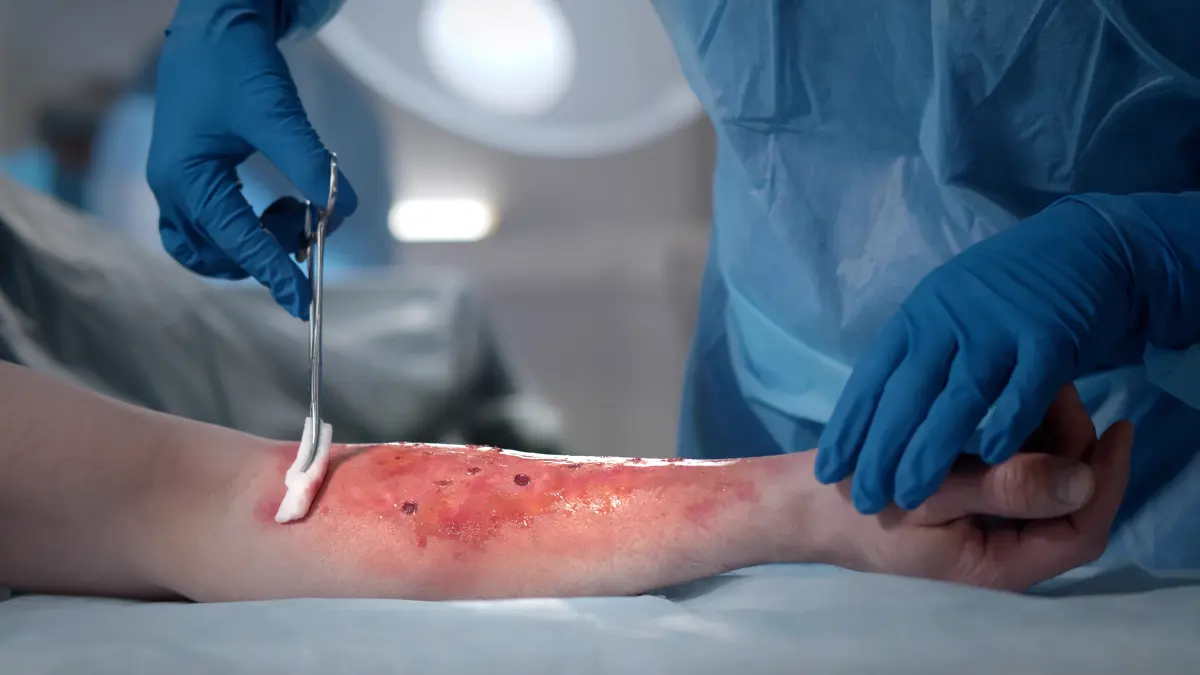 Chirurgen-Team behandelt Verbrennungswunde am Arm eines Patienten im Operationssaal.
