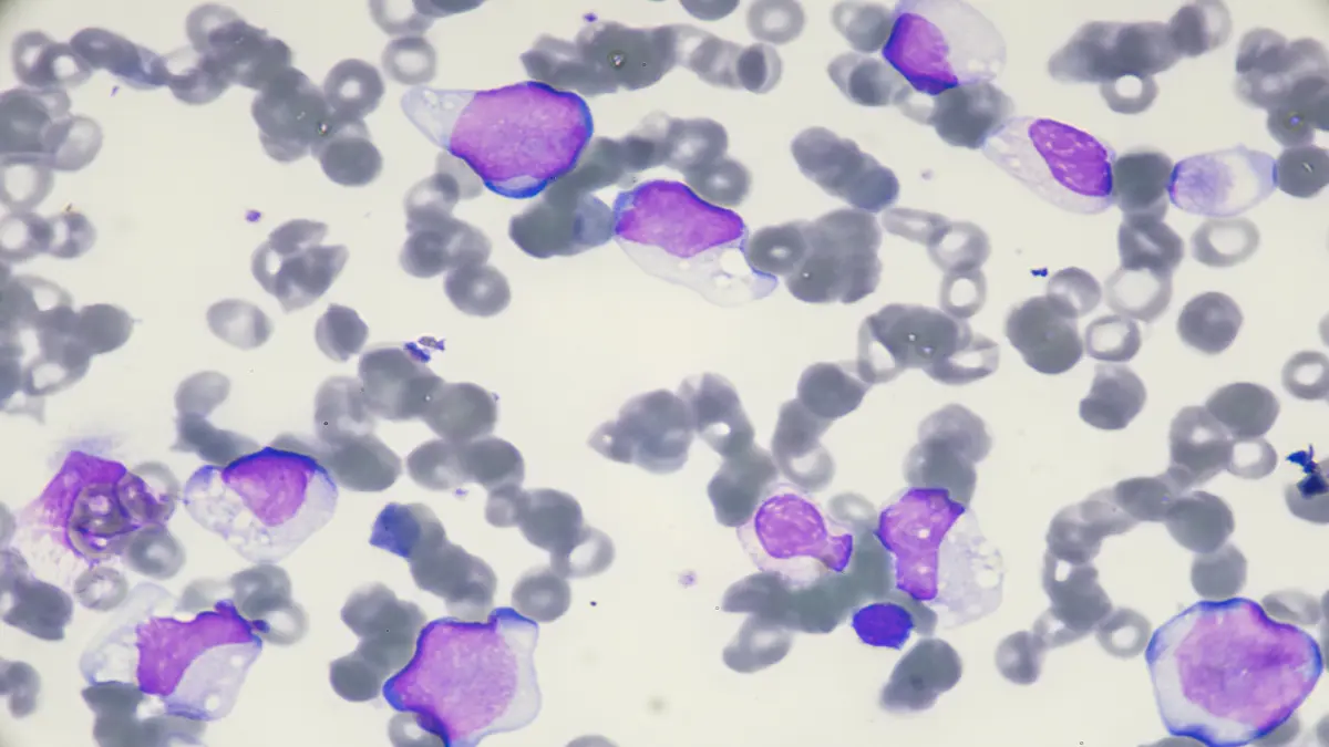 Mikroskopische Ansicht von Blutzellen, die von akuter myeloischer Leukämie (AML) betroffen sind.