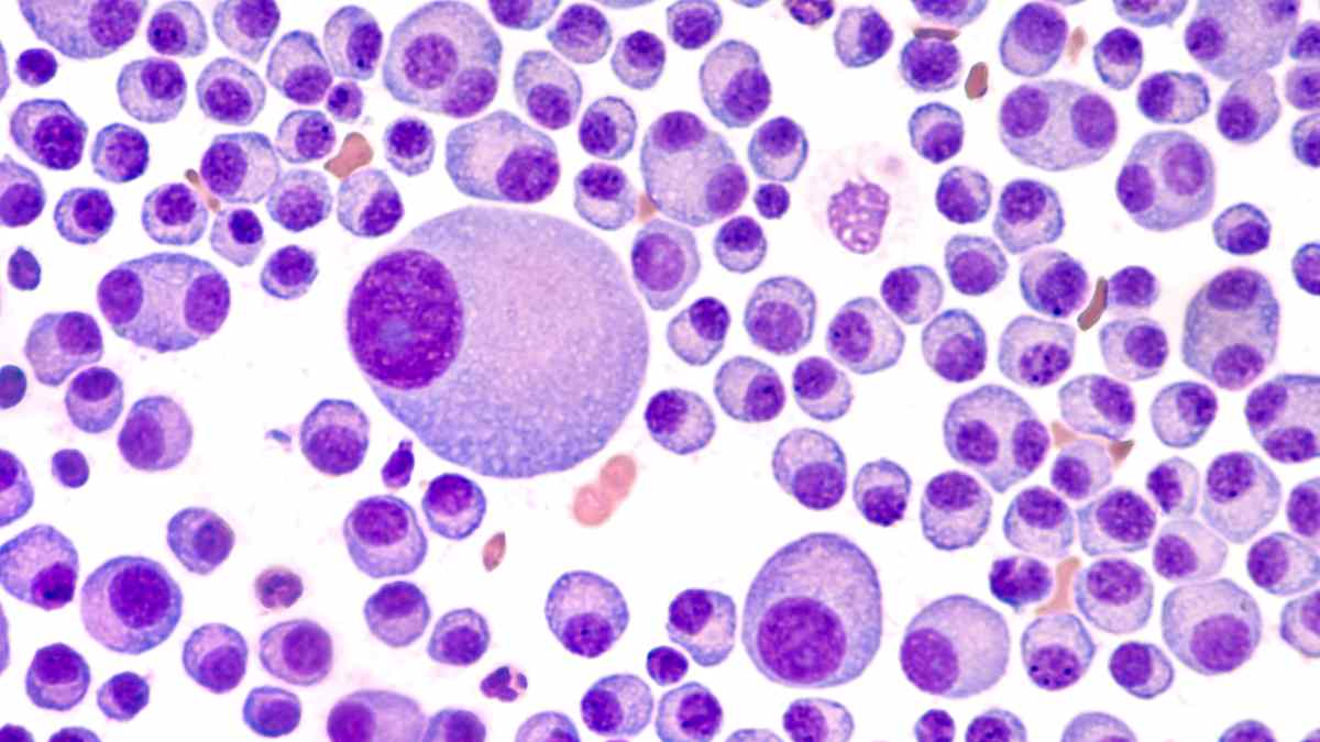Mikroskopische Aufnahme von Zellen des multiplen Myeloms, dargestellt in einer Färbung zur Identifikation von Zellstrukturen.
