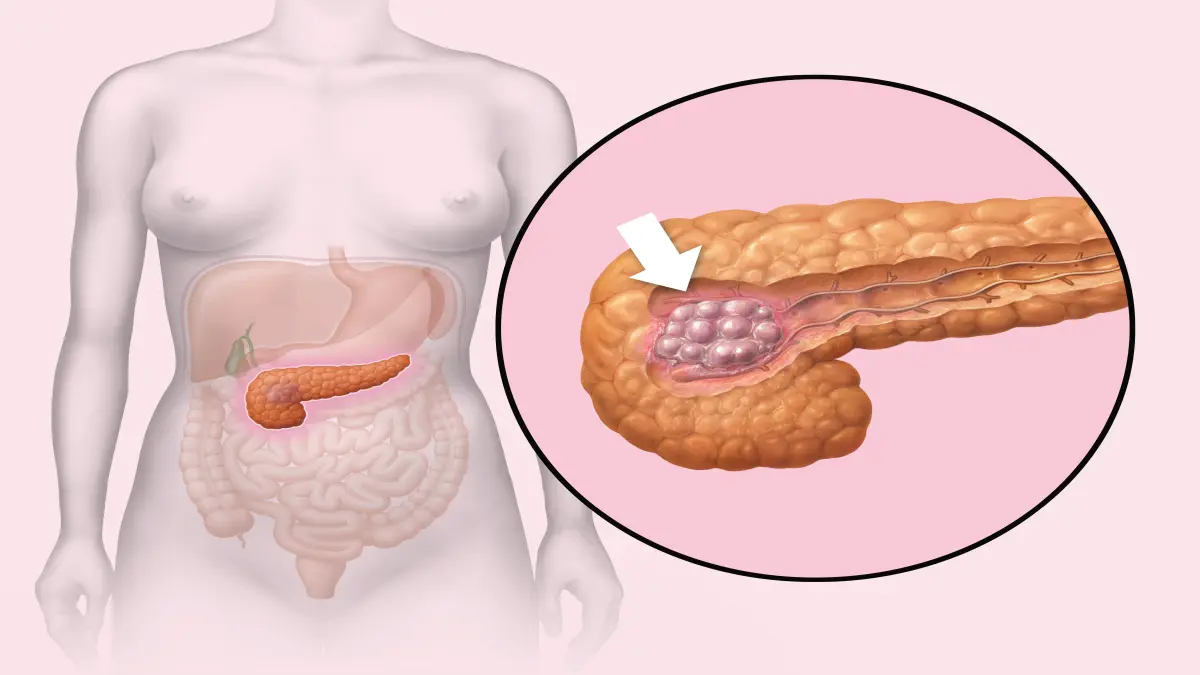 Schematische Darstellung des Pankreas mit hervorgehobenen Tumoren, symbolisiert die Diagnostik und Therapie neuroendokriner Tumoren (Pan-NEN).