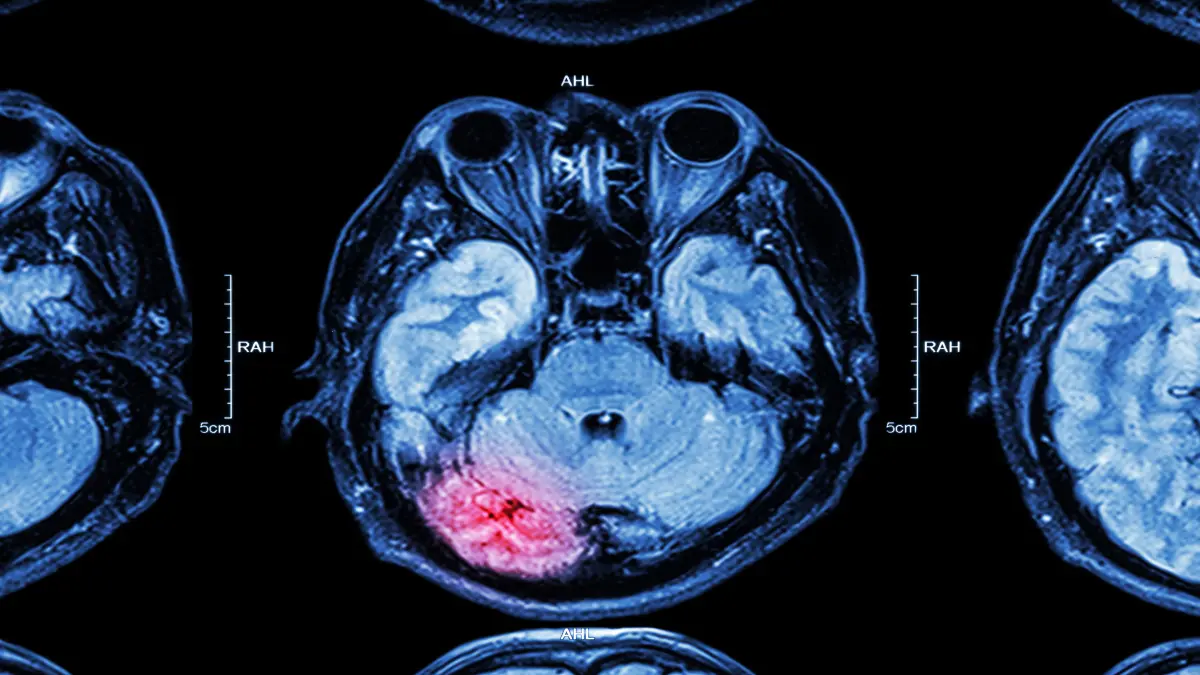 MRT-Aufnahme des Gehirns mit hervorgehobener Schädigung, symbolisiert Neuroenhancement bei nicht-traumatisch bedingten Bewusstseinsstörungen.