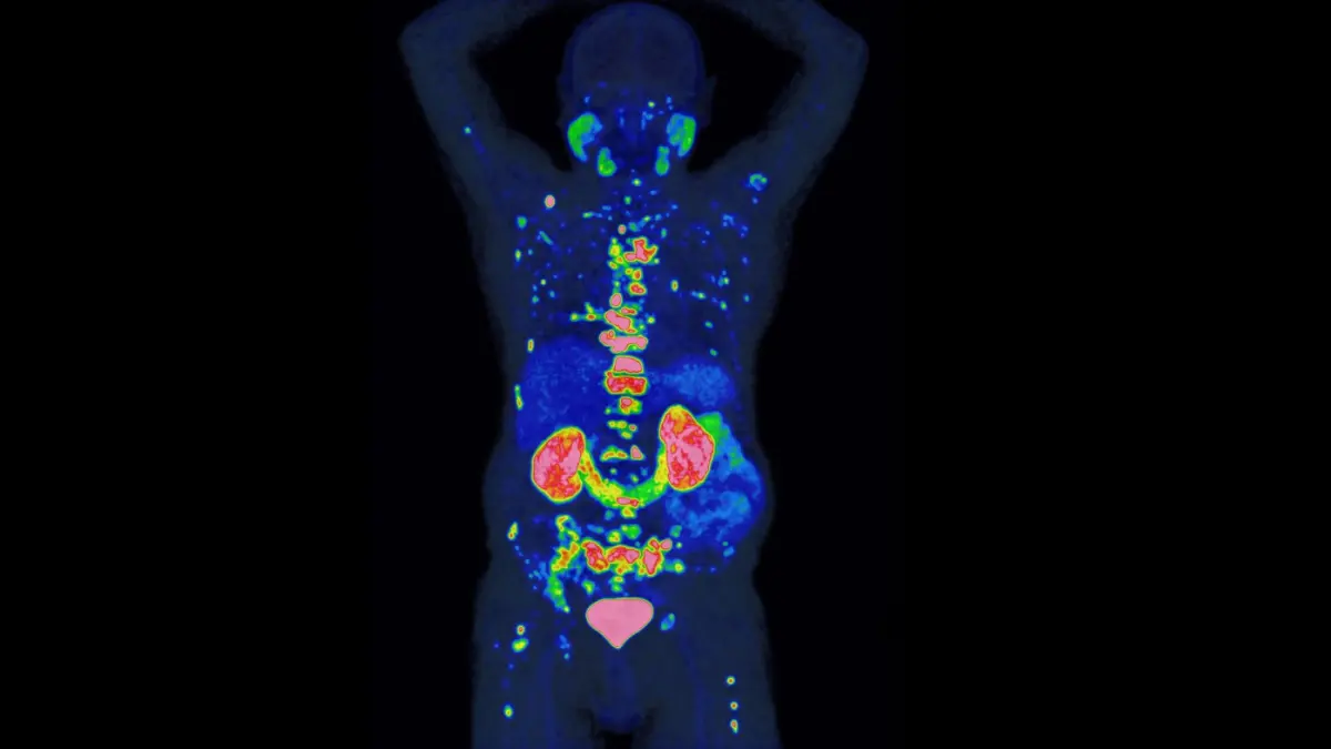 PSMA-PET-Aufnahme zeigt die präzise Darstellung von Prostatakrebszellen und deren Ausbreitung im Körper.