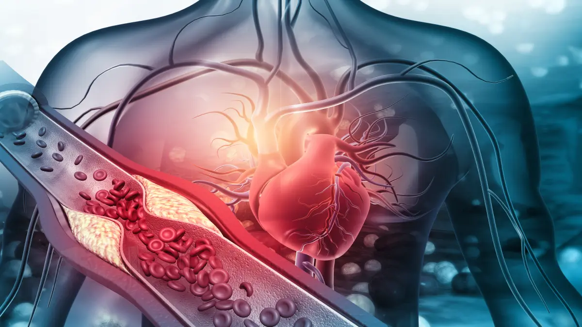 Illustration eines menschlichen Körpers mit hervorgehobenem Herz und verstopften Arterien, die durch Plaque blockiert sind.