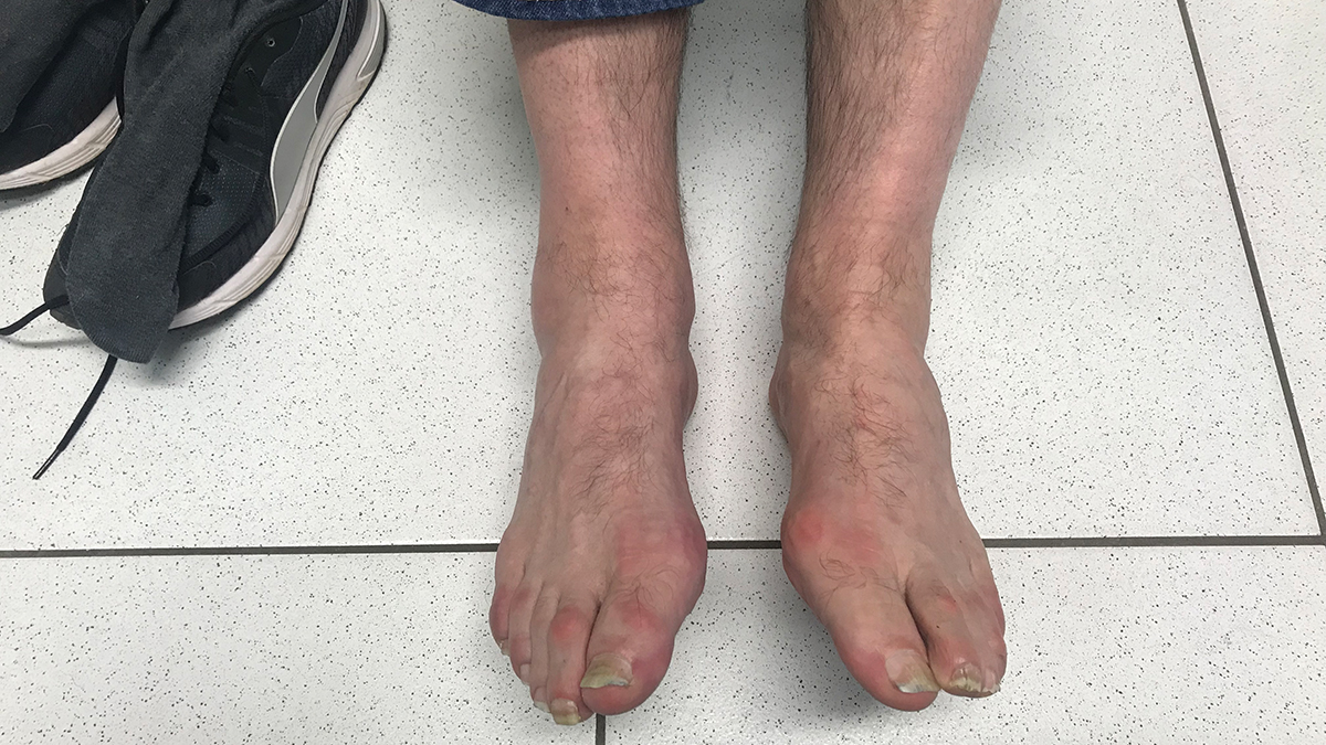 Die Differenzialdiagnosen der Gicht sind bakterielle Gelenkinfektion, andere Kristallarthropathien, aktivierte Arthrose, Stressfrakturen oder ein Erysipel im Gelenkbereich