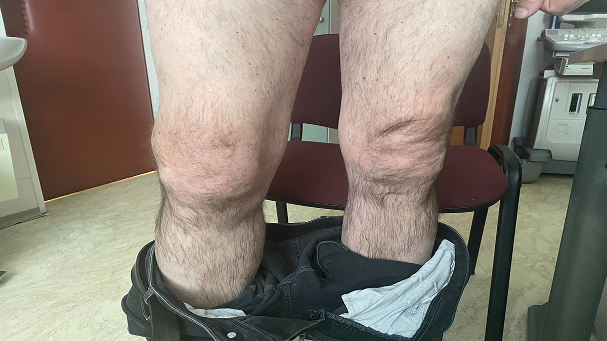 Auch andere Gelenke, wie hier Knie oder Wirbelgelenke, können bei akuten Gichtanfällen betroffen sein