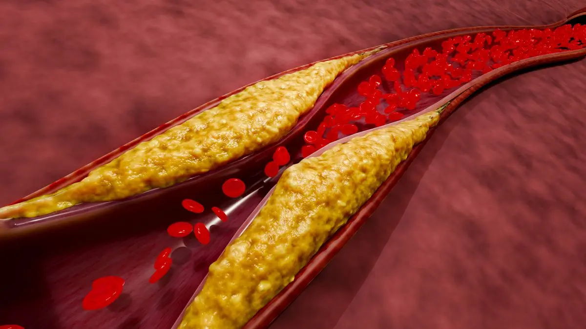 Verengte Blutgefäße durch Arteriosklerose mit roten Blutkörperchen.