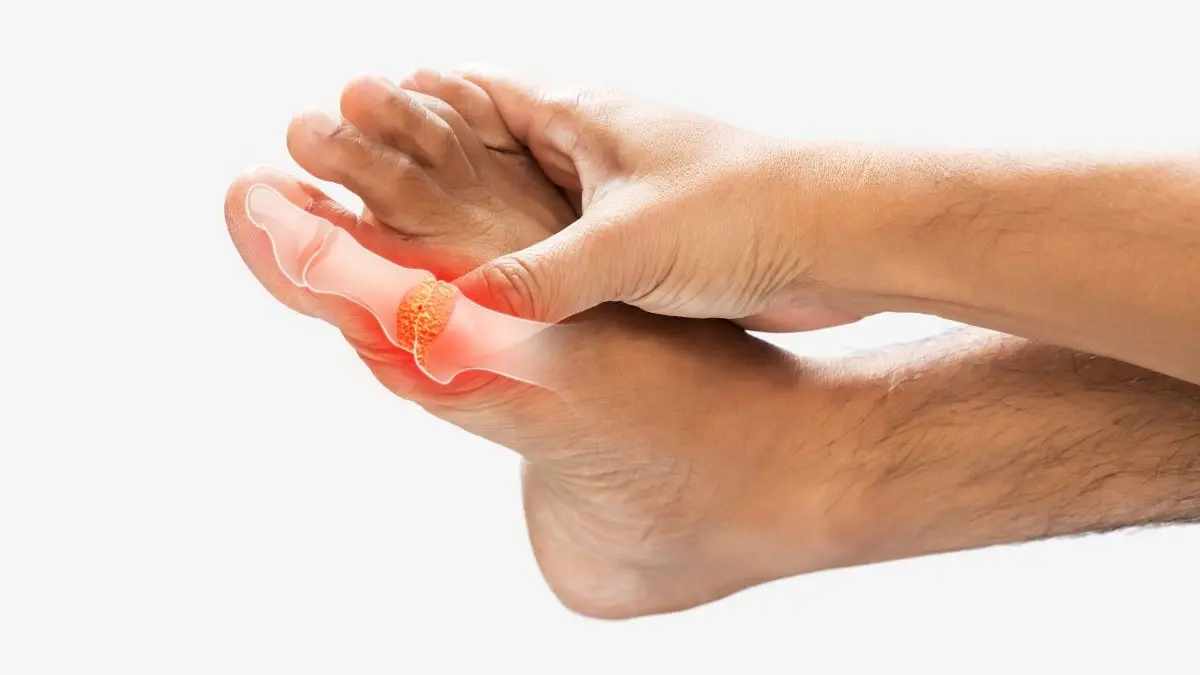 Nahaufnahme eines Fußes mit Gicht am Großzeh, dargestellt durch eine rote Markierung und eine anatomische Illustration. © eddows - stock.adobe.com