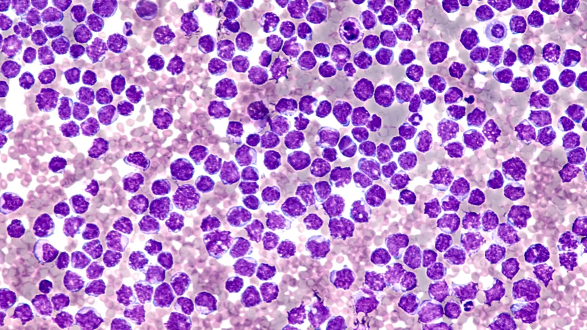 Mikroskopische Aufnahme von Zellen des Mantelzell-Lymphoms, dargestellt in einer speziellen Färbung zur Identifikation von Zellstrukturen.