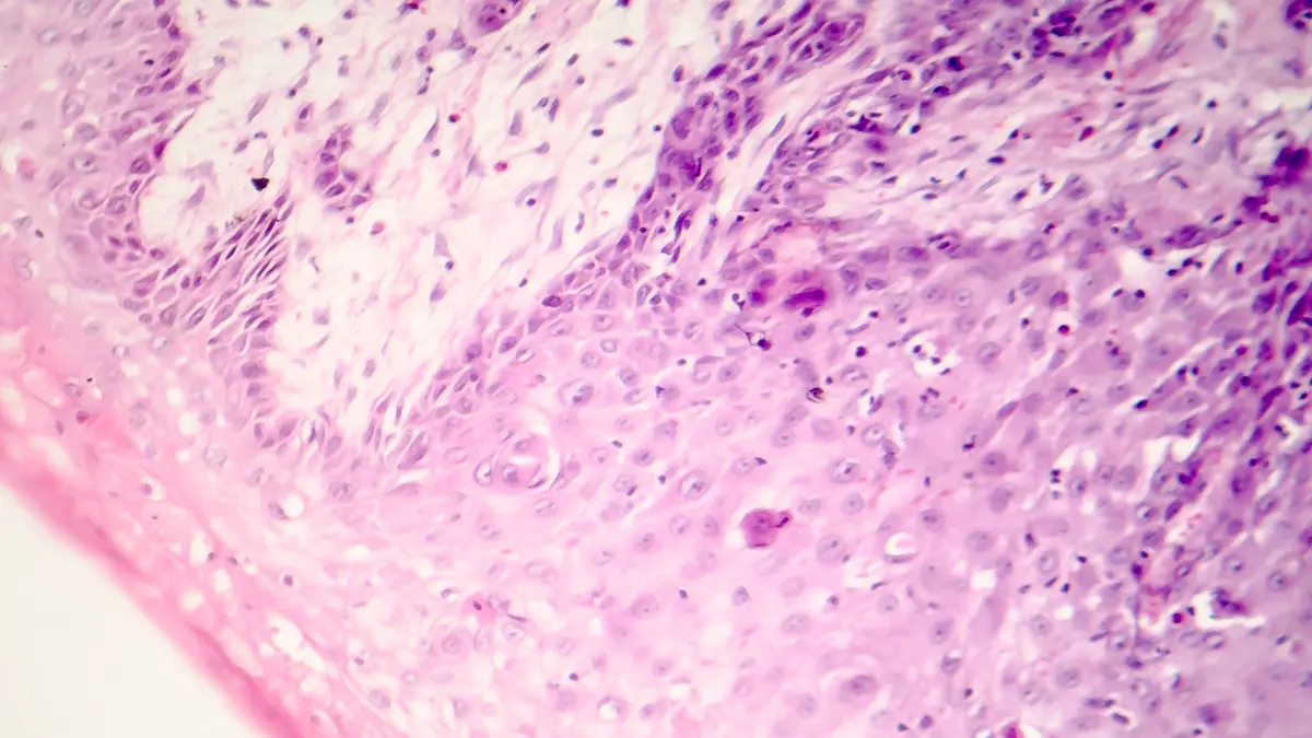 Mikroskopische Ansicht von Gewebe mit Zellstrukturen in Rosa und Lila, kutanes Plattenepithelkarzinom.