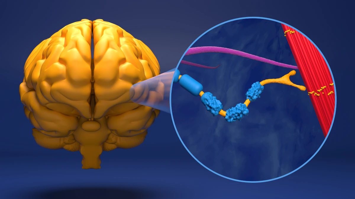 Motor neuron damaged by Amyotrophic Lateral Sclerosis (ALS) - 3d illustration closeup view