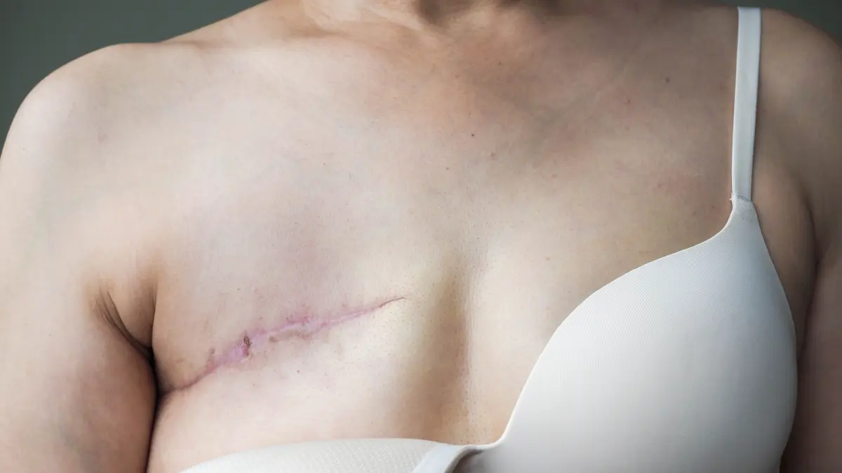 Nahaufnahme einer Brust mit einer Narbe nach einer Brustkrebsoperation, teilweise bedeckt von einem weißen BH