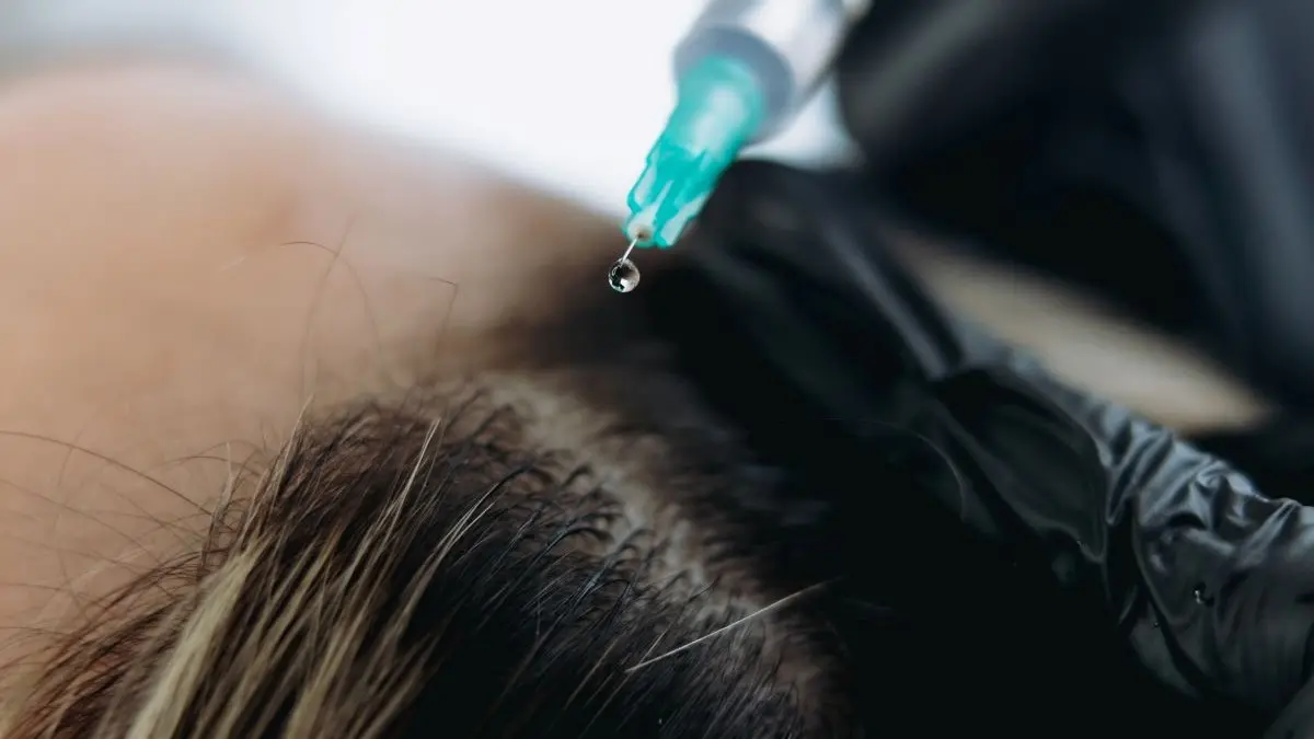 Nahaufnahme einer medizinischen Injektion zur Haarbehandlung mit einer Spritze.