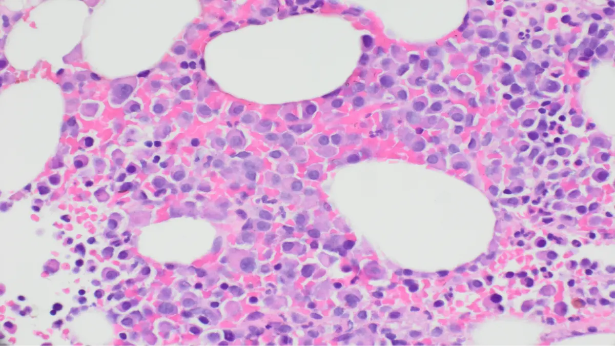 Mikroskopische Aufnahme von Knochenmarkzellen bei einem Patienten mit Multiplem Myelom