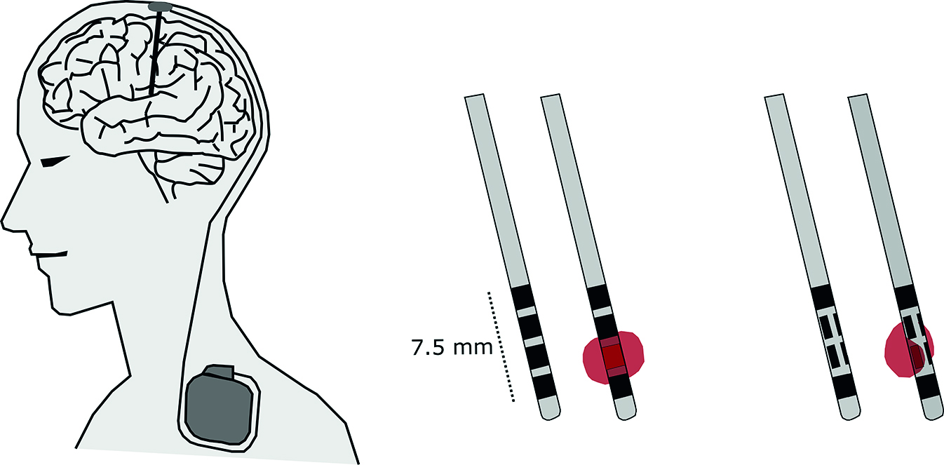 Überblick Tiefe Hirnstimulation