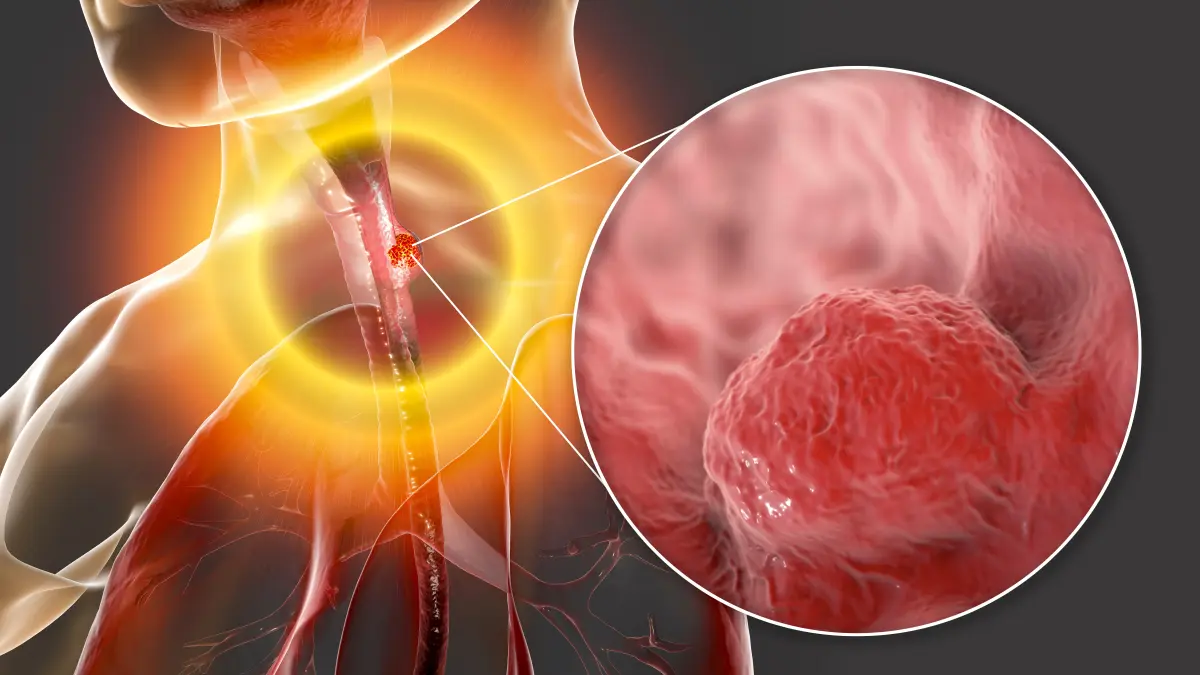 Medizinische Illustration eines Oesophaguskarzinoms (Speiseröhrenkrebs) im menschlichen Oberkörper