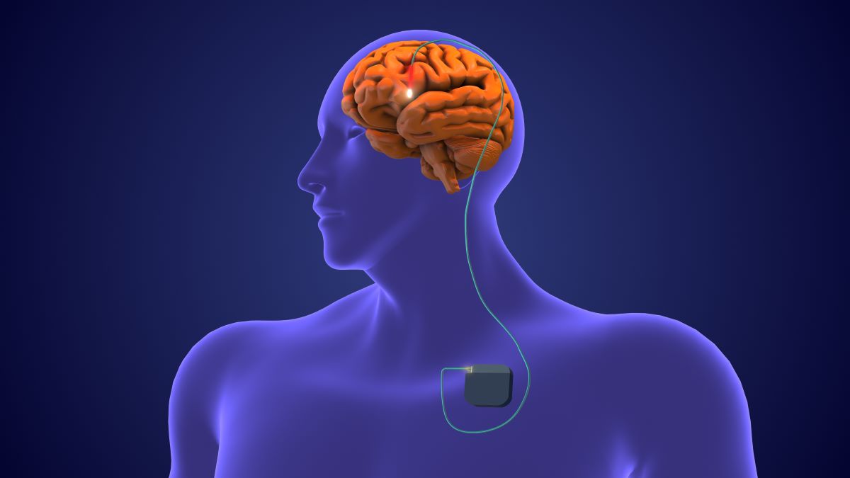 Die Tiefe Hirnstimulation ist eine Option für Patientinnen und Patienten mit fortgeschrittener Parkinson-Krankheit
