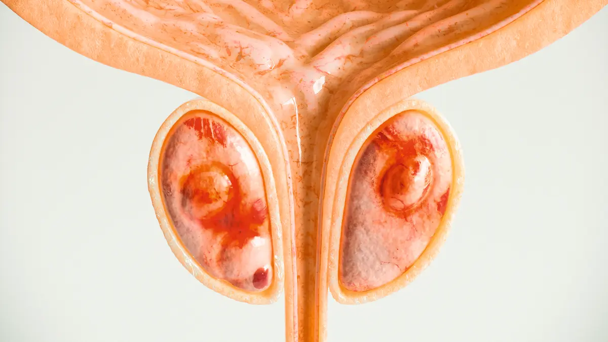 Illustration der Prostata mit Metastasen, Fokus auf moderne Therapieansätze beim metastasierten kastrationsresistenten Prostatakarzinom