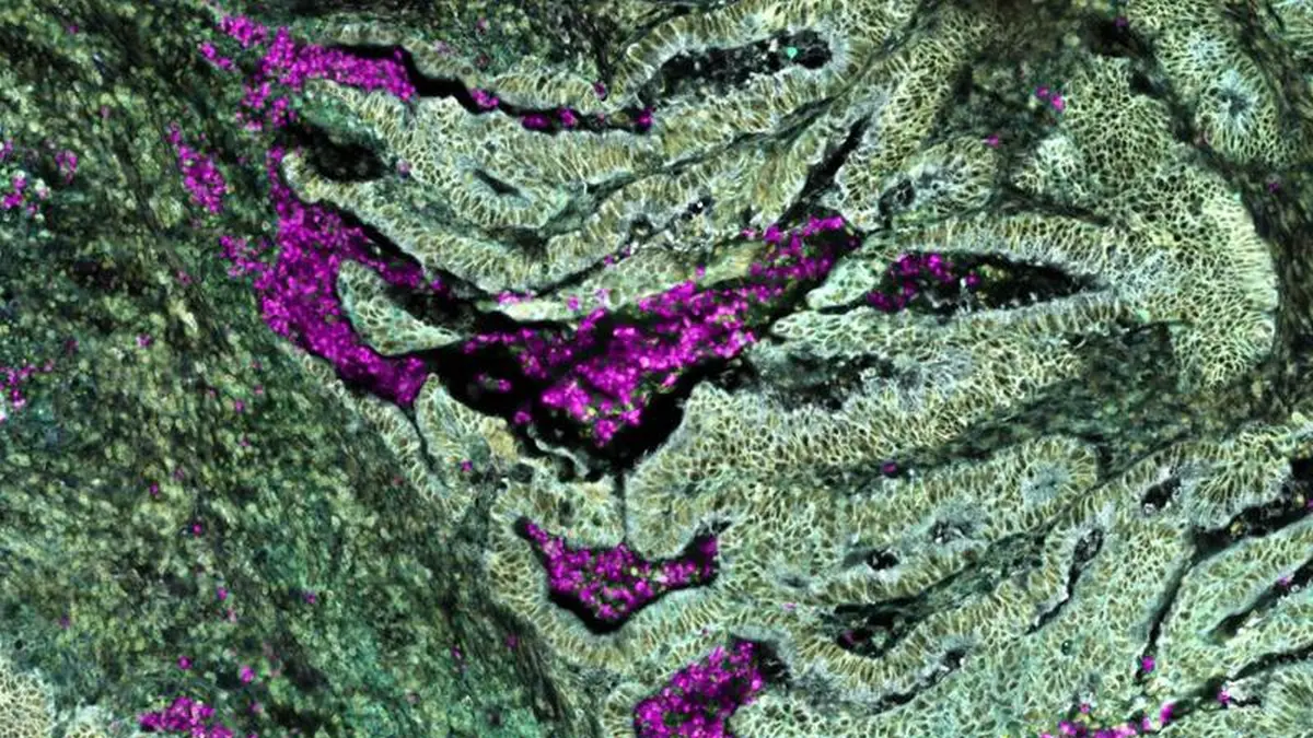Die Visualisierung von Darmkrebs mittels Spatial Transcriptomics (10X Genomics Xenium Plattform) zeigt eine komplexe Gewebearchitektur mit funktionellen zellulären Nischen, in welchen sich Neutrophile (pink) anhäufen.