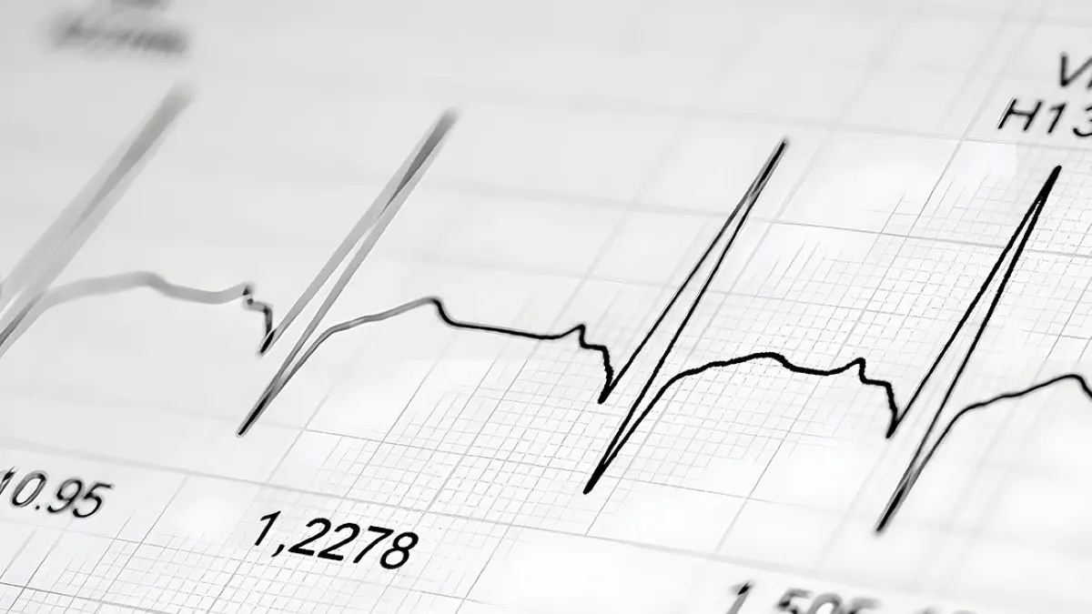 EKG-Darstellung mit unregelmäßigen Herzschlägen, die auf Vorhofflimmern hinweisen können.