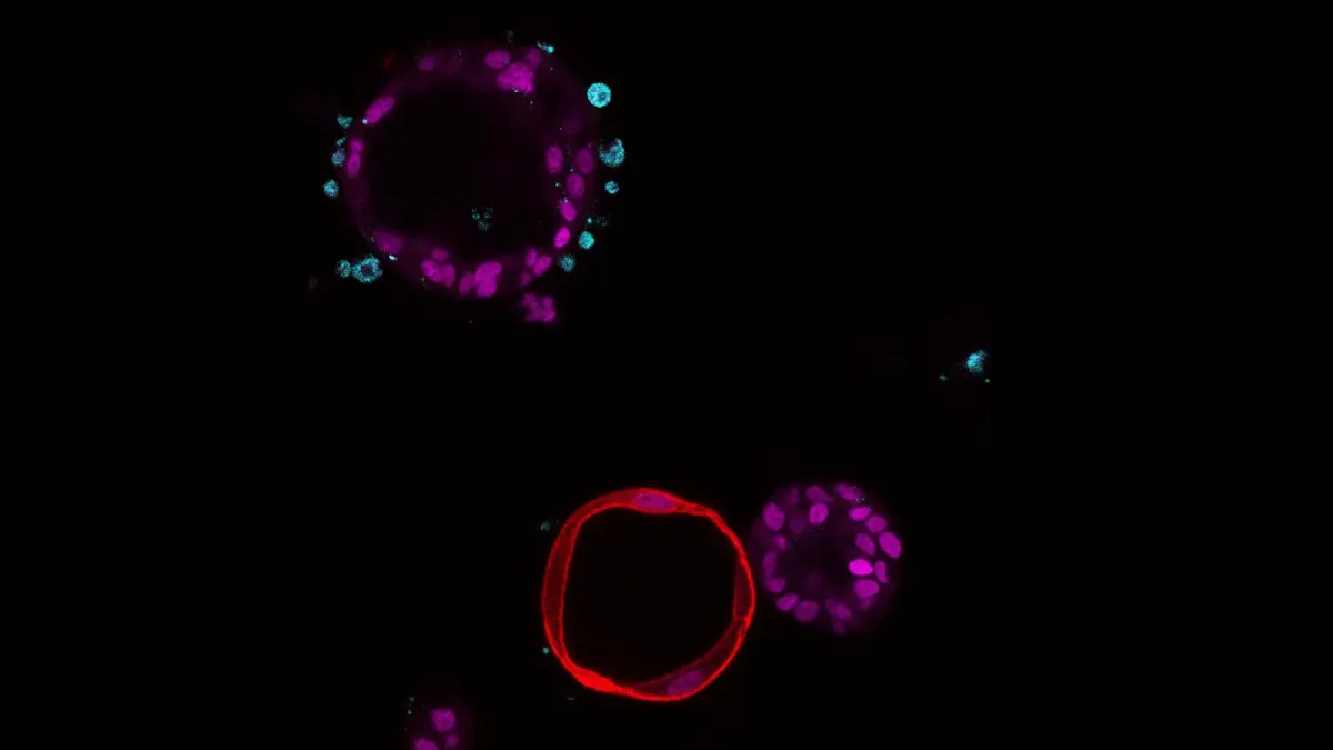 Fluoreszenzmikroskopie-Aufnahme von Pankreas-Organoiden in Ko-Kultur mit T-Zellen – mutiertes KRAS-Onkogen (rot) schützt Tumorzellen vor Immunantwort bei Bauchspeicheldrüsenkrebs