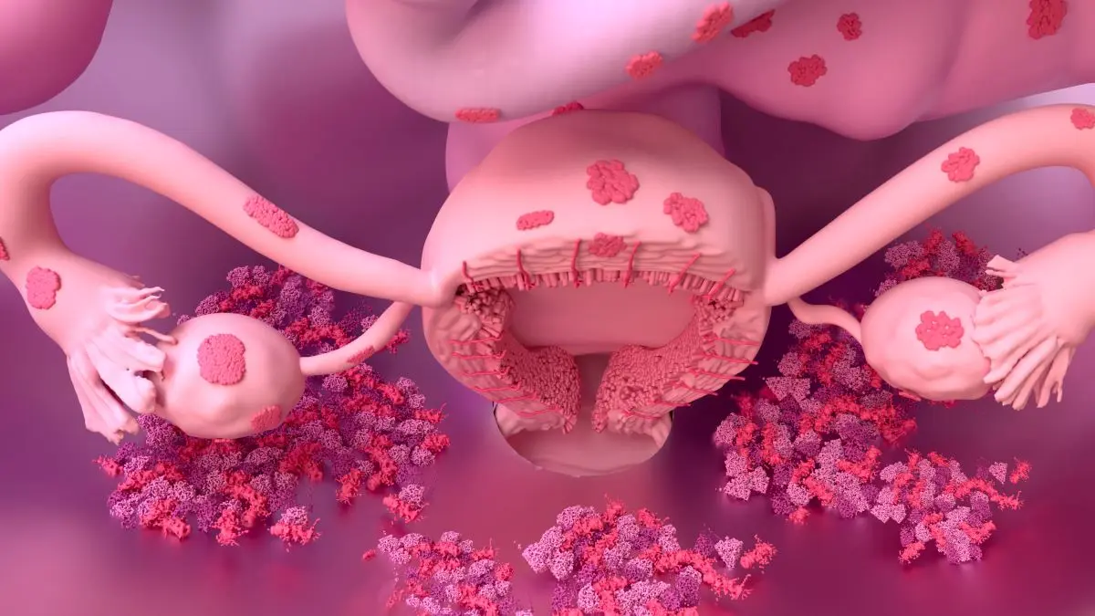 3D-Darstellung des weiblichen Reproduktionssystems mit Endometriose-Herden an Uterus und Ovarien.
