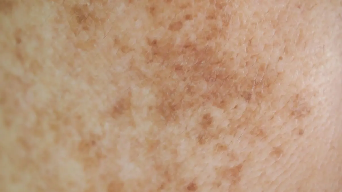 Nahaufnahme von Haut mit Pigmentflecken und Hyperpigmentierung als Beispiel fuer topische Behandlungsansaetze