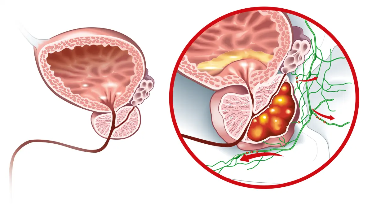 Medizinische Illustration zur Ausbreitung von Prostatakrebs und Lymphknotenmetastasen – moderne Diagnostik mit PSMA/PET und Sentinel-Lymphadenektomie