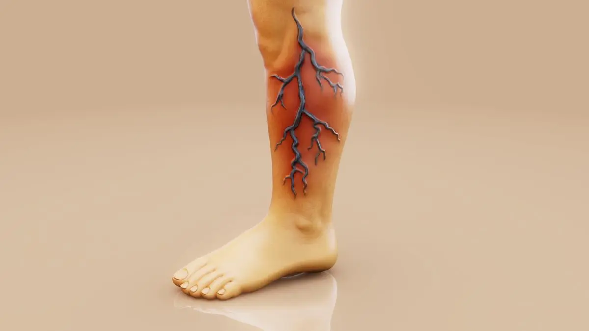 Medizinische Illustration eines Beins mit Thrombose und entzündeten Venen