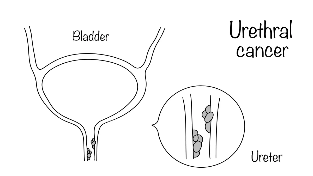 Medizinische Illustration eines Urethrakarzinoms – anatomische Darstellung von Harnblase und Harnröhre mit Tumorwachstum in der Urethra
