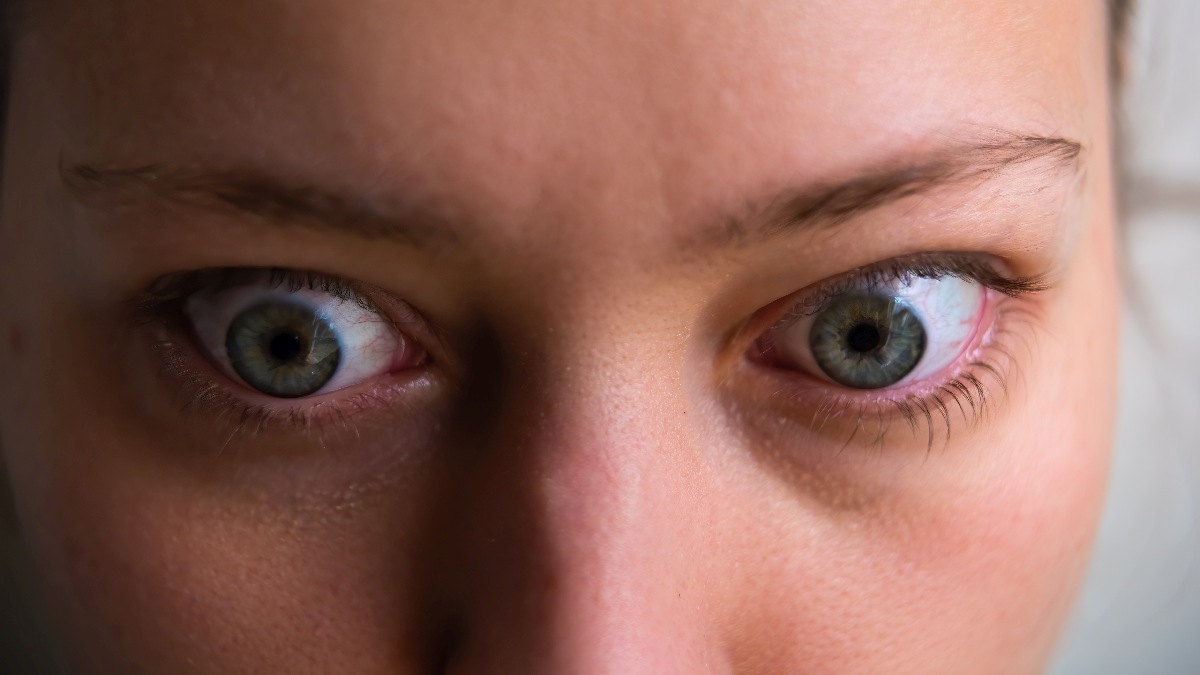 Exophthalmus