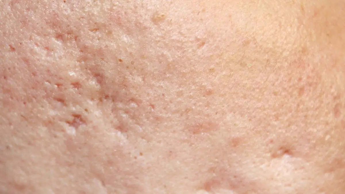 Nahaufnahme von Haut mit atrophen Akne-Narben – klinisches Bild fuer Dermatologie und aesthetische Behandlung