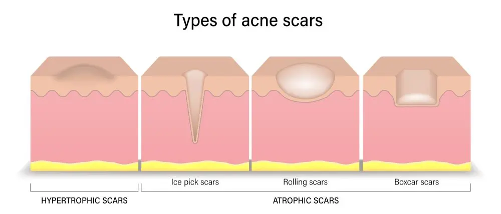 Infografik zu Aknenarben-Typen: Hypertrophe Narben, Ice-Pick-Scars, Rolling Scars und Boxcar Scars im Hautquerschnitt