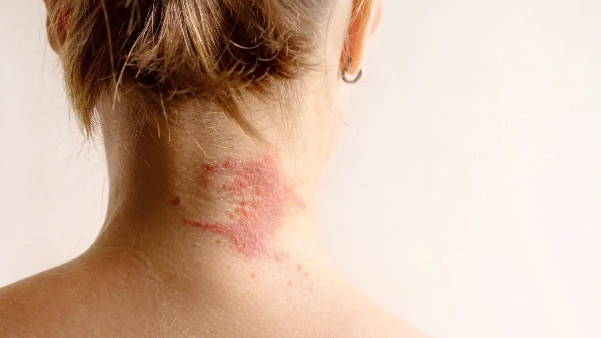 Geraetete Ekzem-Haut am Nacken als Sonderlokalisaton bei Atopischer Dermatitis