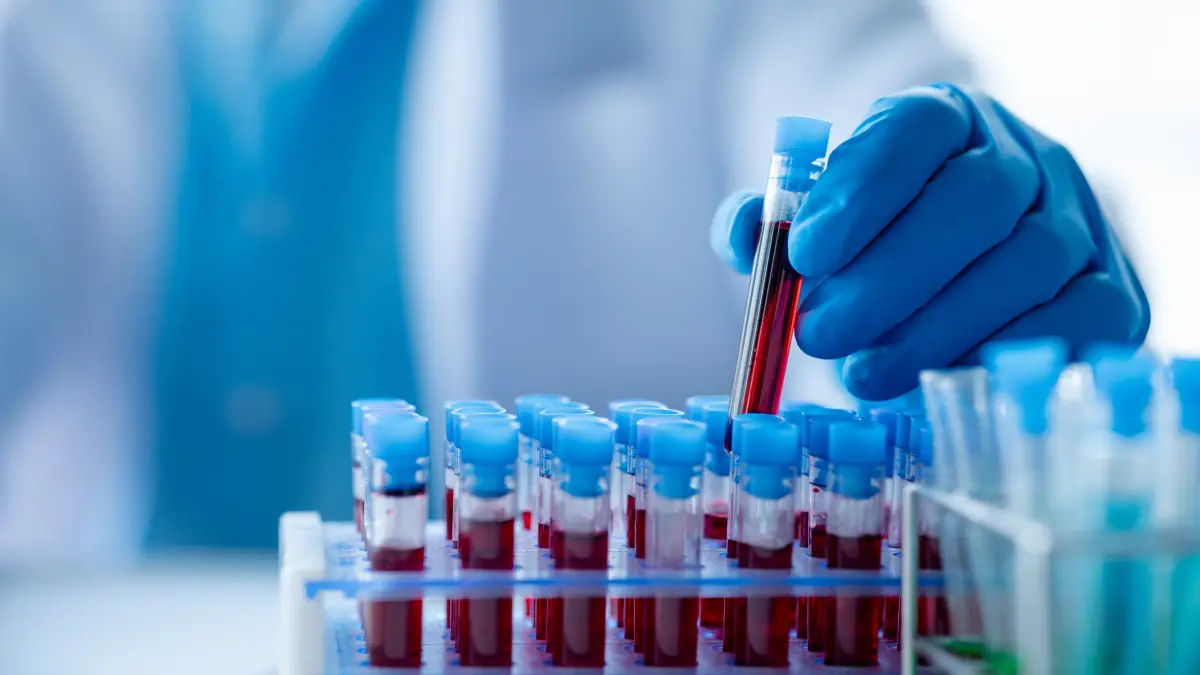 Laborant mit blauen Handschuhen entnimmt Blutprobe aus Reagenzglas-Rack – Bluttest zur Vorhersage von Immuntherapie-Nebenwirkungen