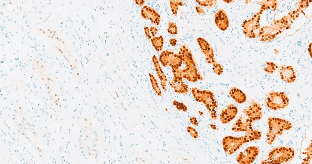 Abb. 2: Immunhistochemische Färbung zur Bestätigung der Prostatakarzinommetastase, NKX3.1-Färbung