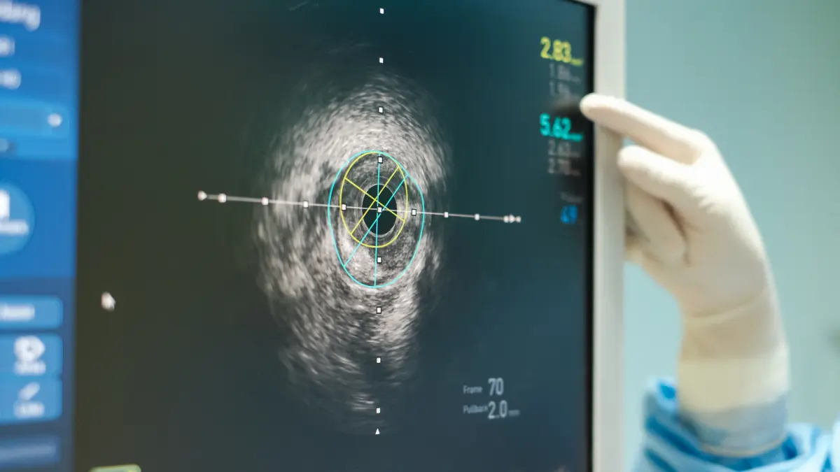 Arzt zeigt auf IVUS-Monitor mit Querschnittsbild einer Koronararterie – Diagnostik beim chronischen Koronarsyndrom