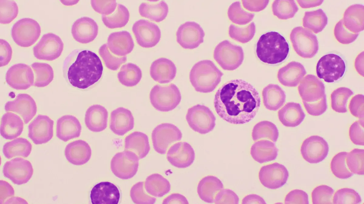 Mikroskopische Aufnahme eines Blutausstrichs mit charakteristischen Lymphozyten bei chronisch lymphatischer Leukämie (CLL)