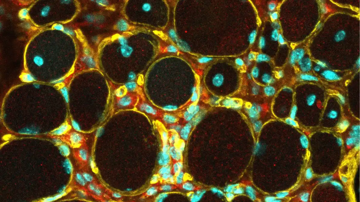 Bei der LAMA2-Muskeldystrophie ist das Muskelfasergerüst (gelb) geschwächt, sodass Muskelfasern degenerieren und Immunzellen (rot) in das Gewebe einwandern.