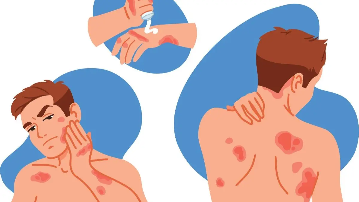 Illustration eines Mannes mit Hautausschlag und Juckreiz als Symptome atopischer Dermatitis sowie Creme-Auftragen auf betroffene Haut