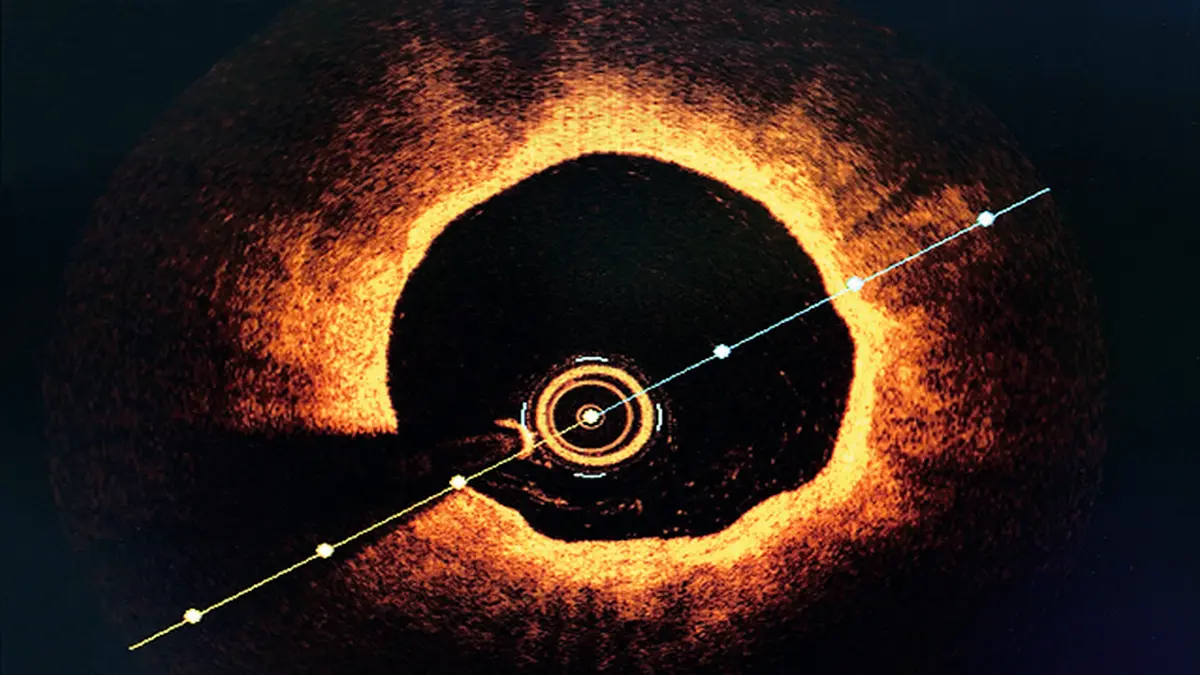 Intravaskulärer Ultraschall (IVUS) einer Koronararterie mit Messlinien – Bildgebung in der Herzdiagnostik