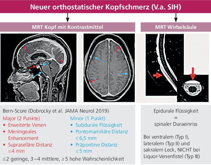 Abb. 1: Diagnostisches Vorgehen mit MRT bei Orthostatischen Kopfschmerzen. 