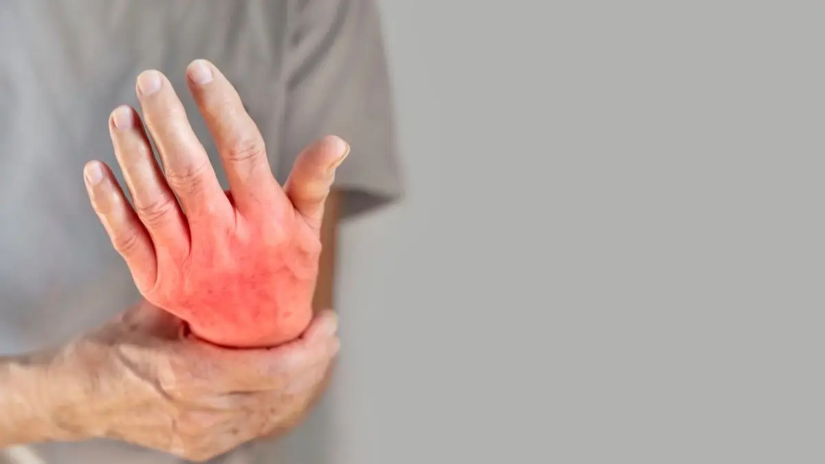 Gerötete entzündete Hand als Symbol fuer Psoriasis-Arthritis und Gelenkschmerzen