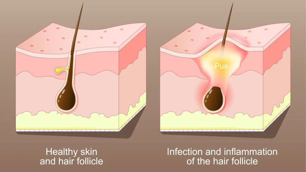 Medizinische Illustration von gesunder Haarwurzel und entzündeter Follikulitis als Ursache akneiformer Kopfhautlaesionen und Haarausfall