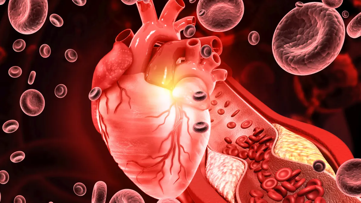 3D-Illustration eines Herzens mit Querschnitt eines durch Cholesterin-Plaque verengten Blutgefäßes