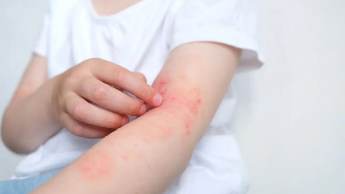 Kind kratzt an geröteter Hautstelle am Arm als typisches Symptom einer atopischen Dermatitis